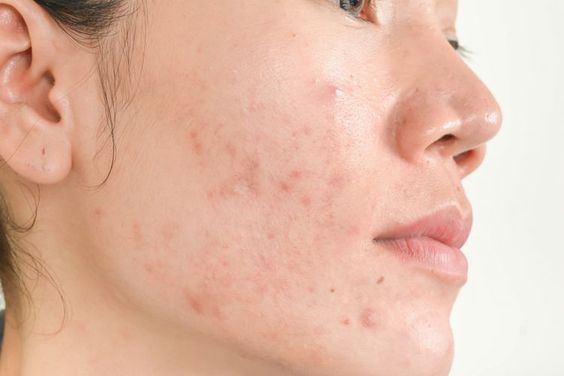 Cara Menghilangkan Bekas Jerawat dengan Skincare yang Tepat