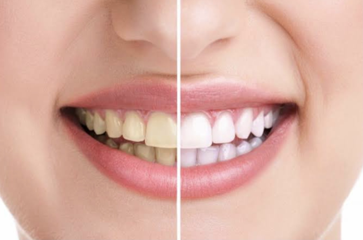 12 Cara Memutihkan Gigi Alami Tanp Efek Samping, Bahan-Bahannya Ada di Dapur!