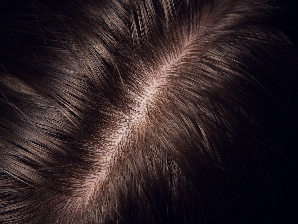 4 Tips Merawat Kulit Kepala Agar Tetap Sehat: Ketombe Hilang dalam 1 Minggu