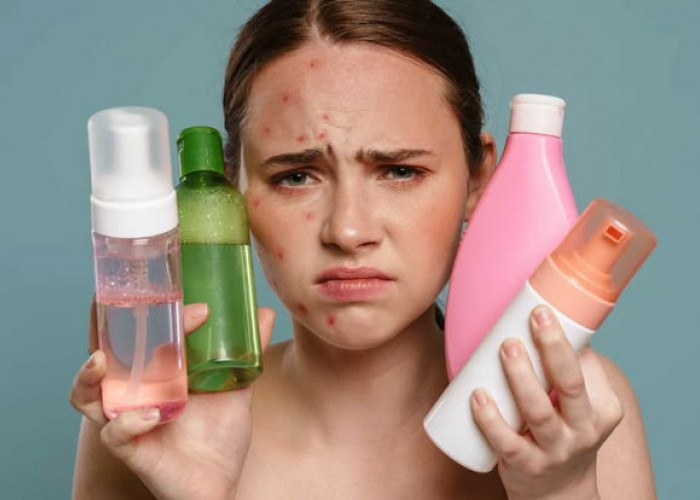 Penyebab Muka Breakout dan Cara Mengatasinya Secara Alami