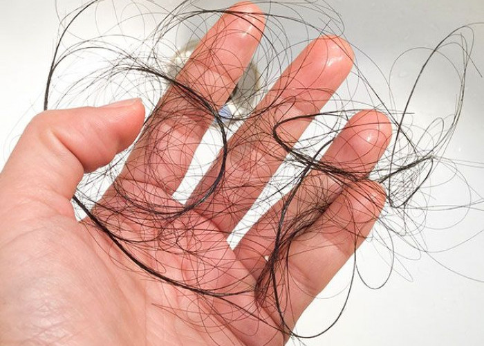 Cara Mengatasi Rambut Rontok Parah Menggunakan Bahan Alami di Rumah