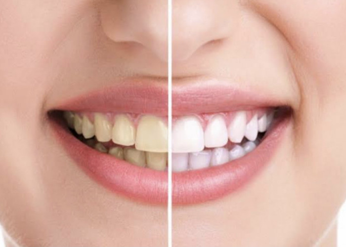 12 Cara Memutihkan Gigi Alami Tanp Efek Samping, Bahan-Bahannya Ada di Dapur!