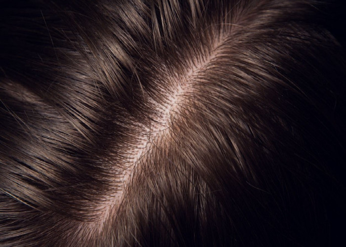 4 Tips Merawat Kulit Kepala Agar Tetap Sehat: Ketombe Hilang dalam 1 Minggu