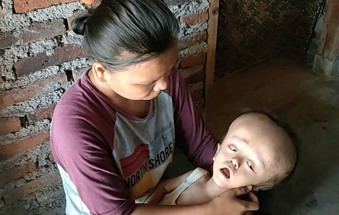 Tak Ada Biaya, Bocah Hydrocephalus Warga Karangampel Dirawat di Rumah